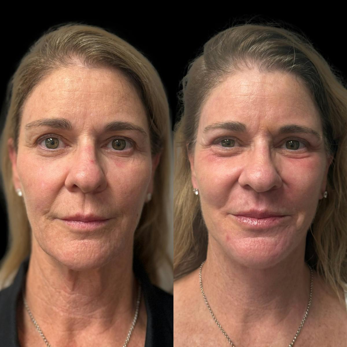 Facelift Before & After Gallery - Patient 103775 - Image 5