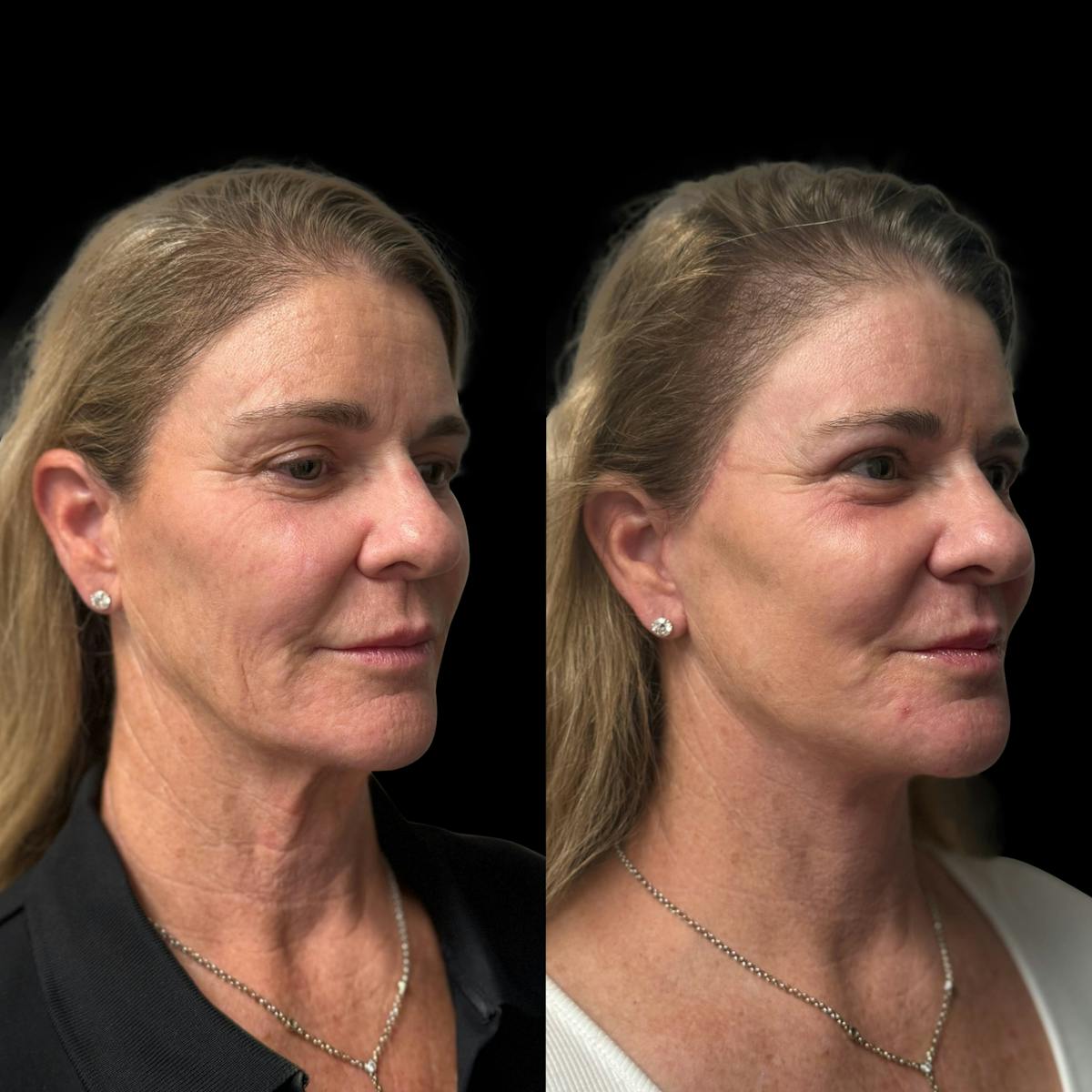 Facelift Before & After Gallery - Patient 103775 - Image 2