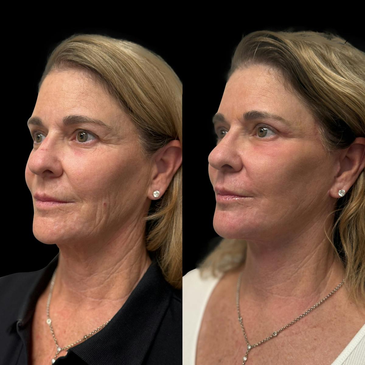 Facelift Before & After Gallery - Patient 103775 - Image 4
