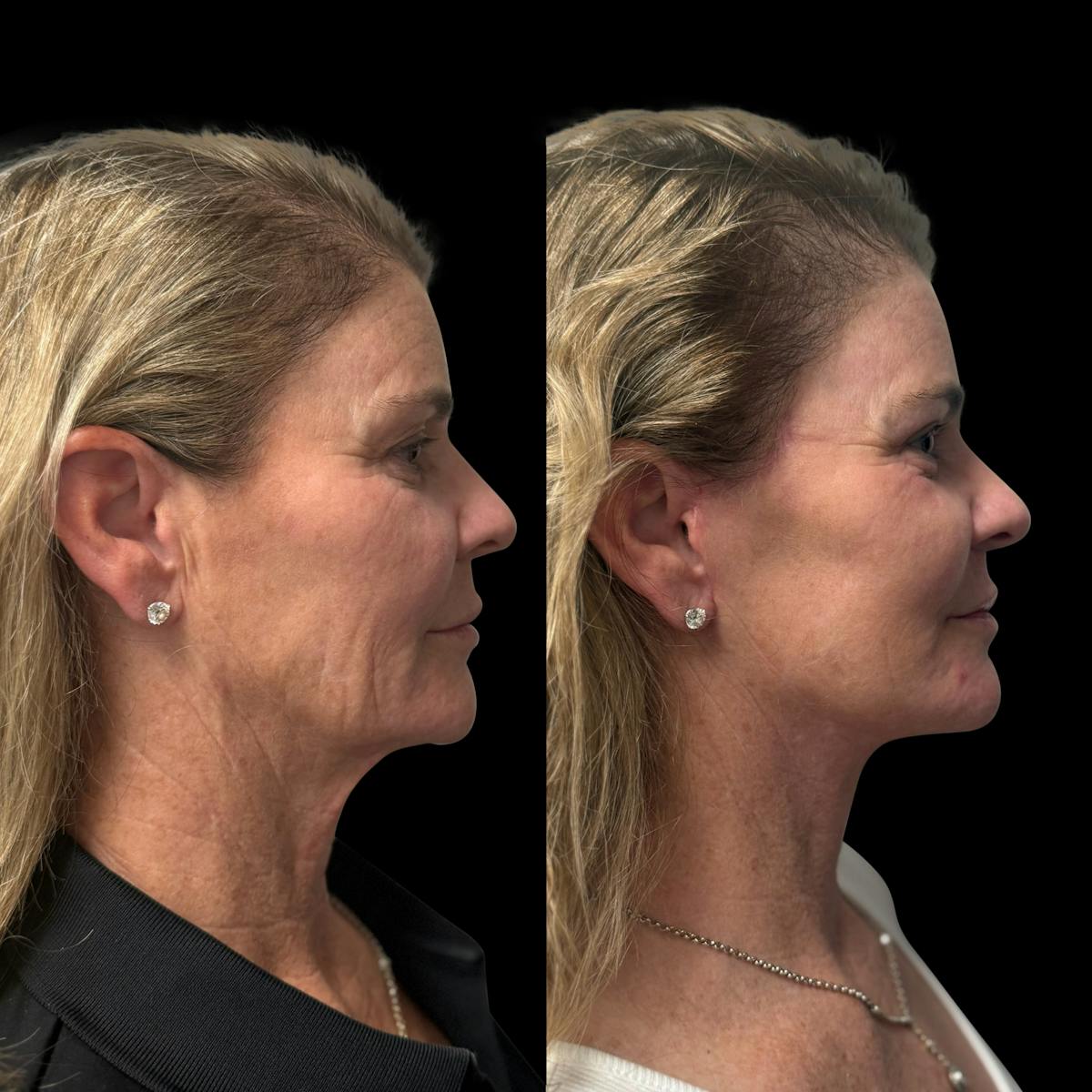 Facelift Before & After Gallery - Patient 103775 - Image 3