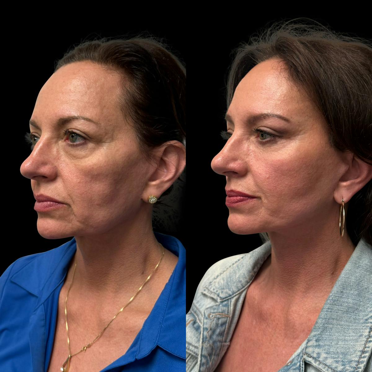 Facelift Before & After Gallery - Patient 496746 - Image 4