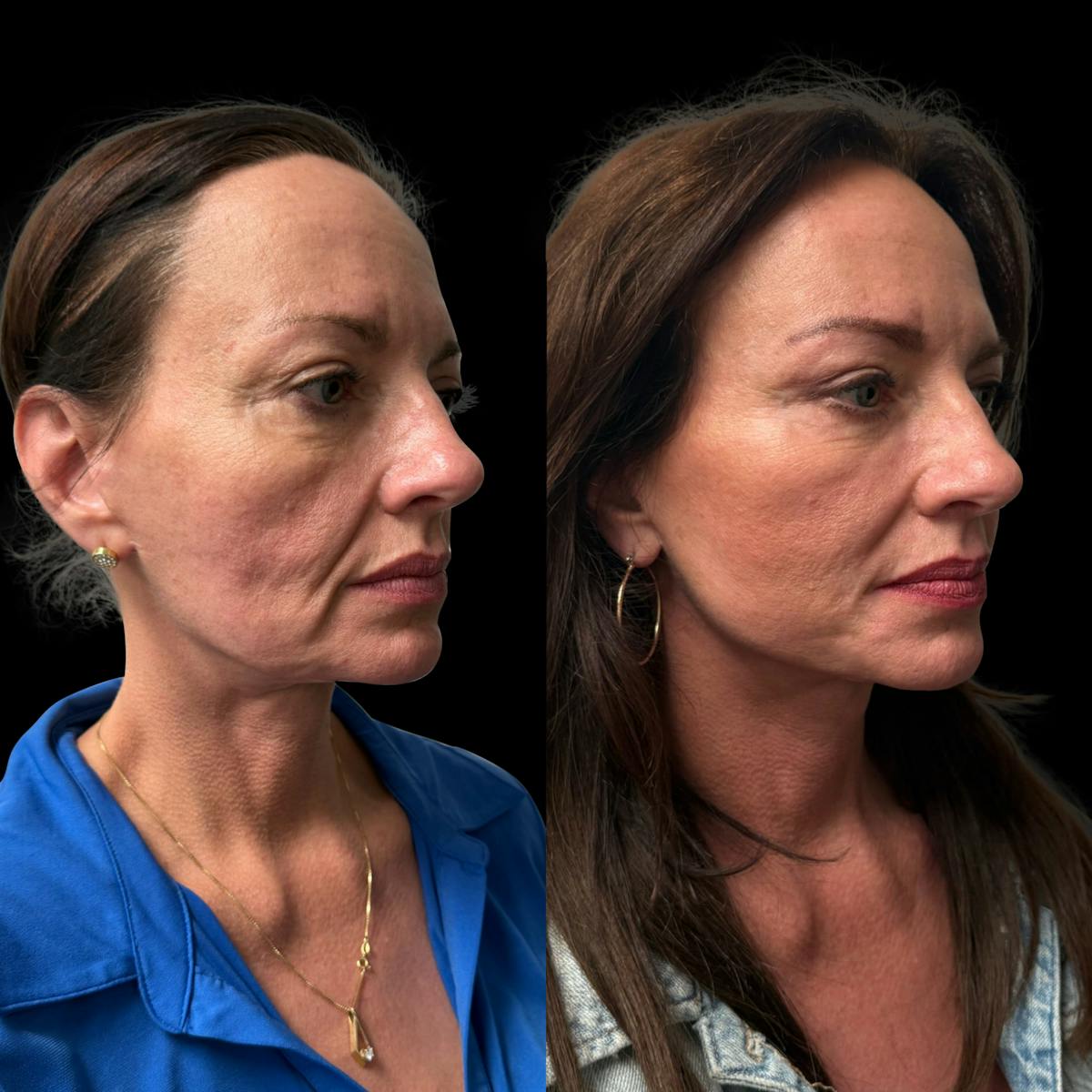 Facelift Before & After Gallery - Patient 496746 - Image 2
