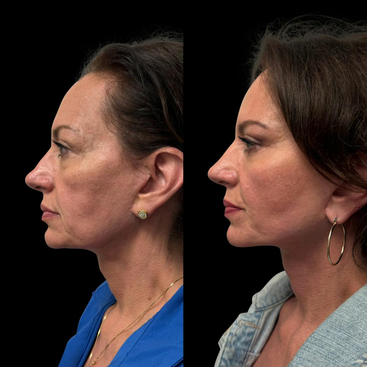 Facelift Before & After Gallery - Patient 496746 - Image 5