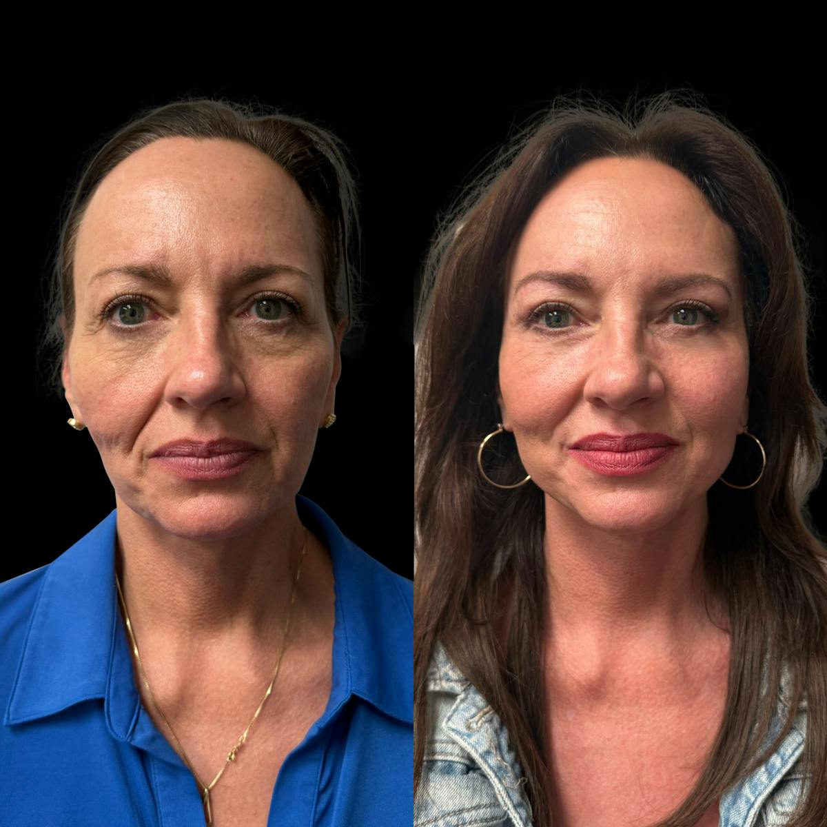 Facelift Before & After Gallery - Patient 496746 - Image 1