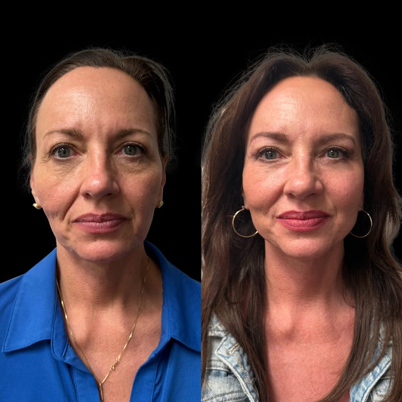 Facelift Before & After Gallery - Patient 496746 - Image 1