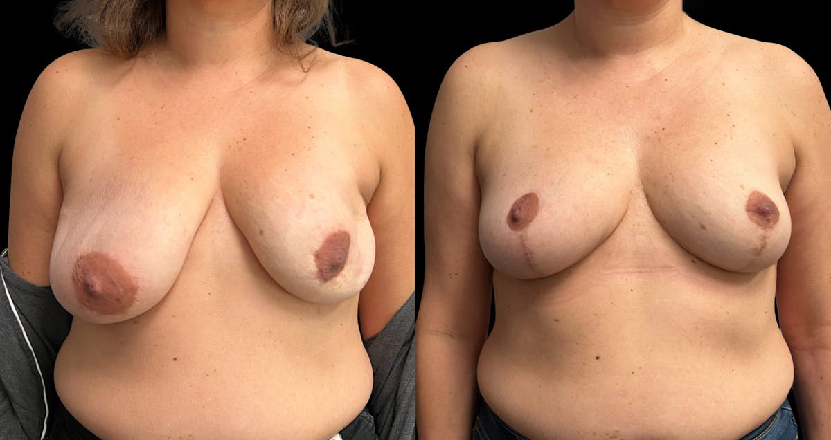 Breast Lift Before & After Gallery - Patient 488995 - Image 1