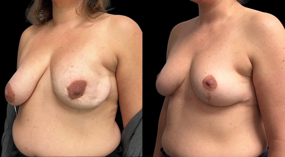 Breast Lift Before & After Gallery - Patient 488995 - Image 4