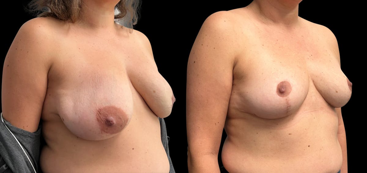 Breast Lift Before & After Gallery - Patient 488995 - Image 3