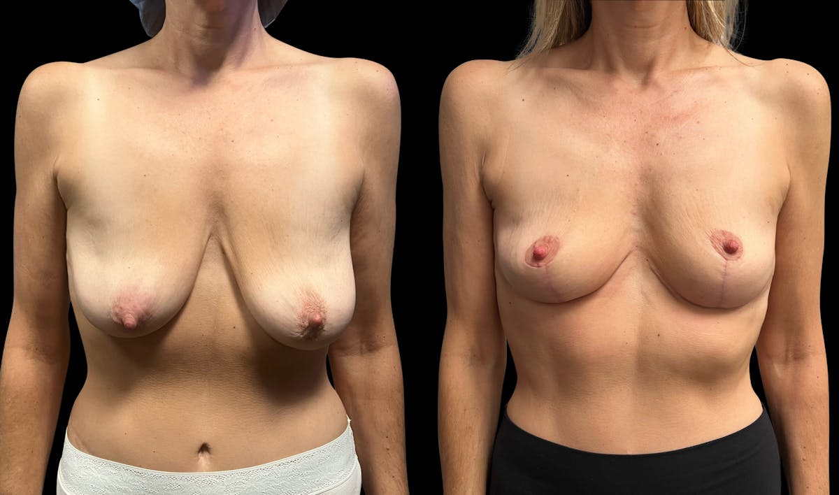 Breast Lift Before & After Gallery - Patient 211158 - Image 1