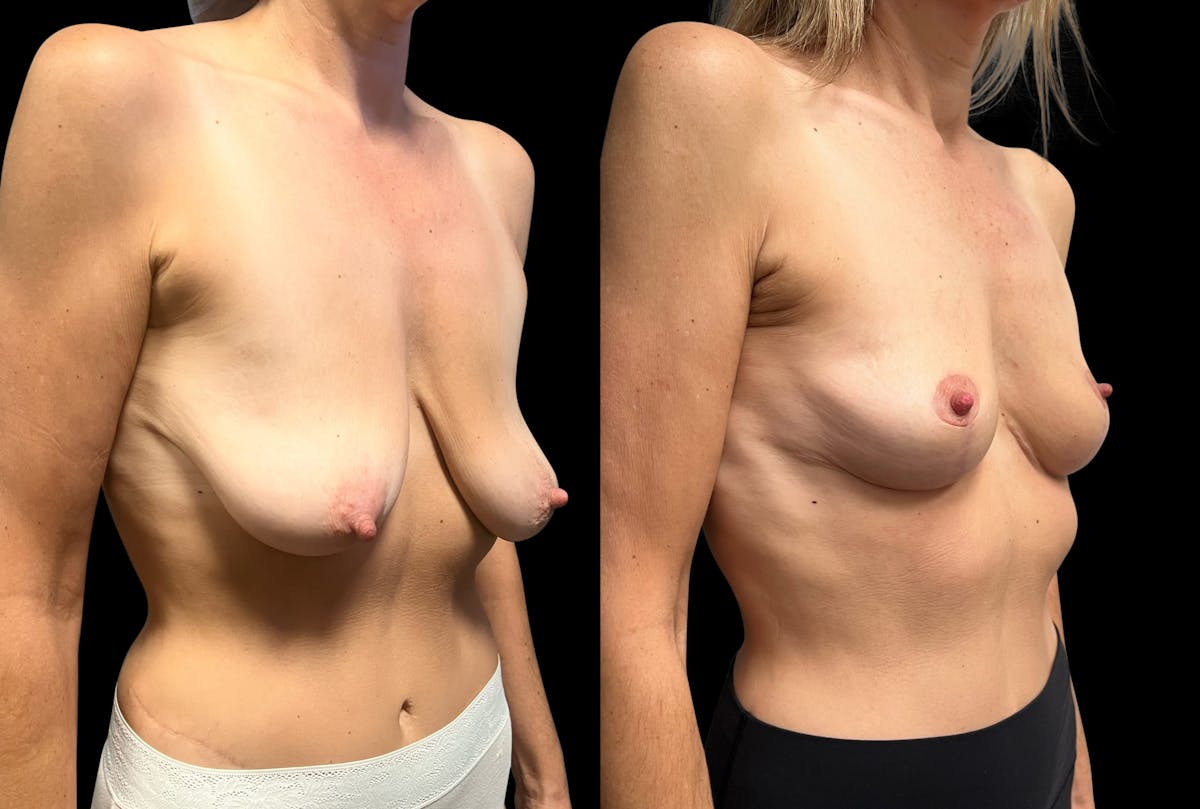 Breast Lift Before & After Gallery - Patient 211158 - Image 2