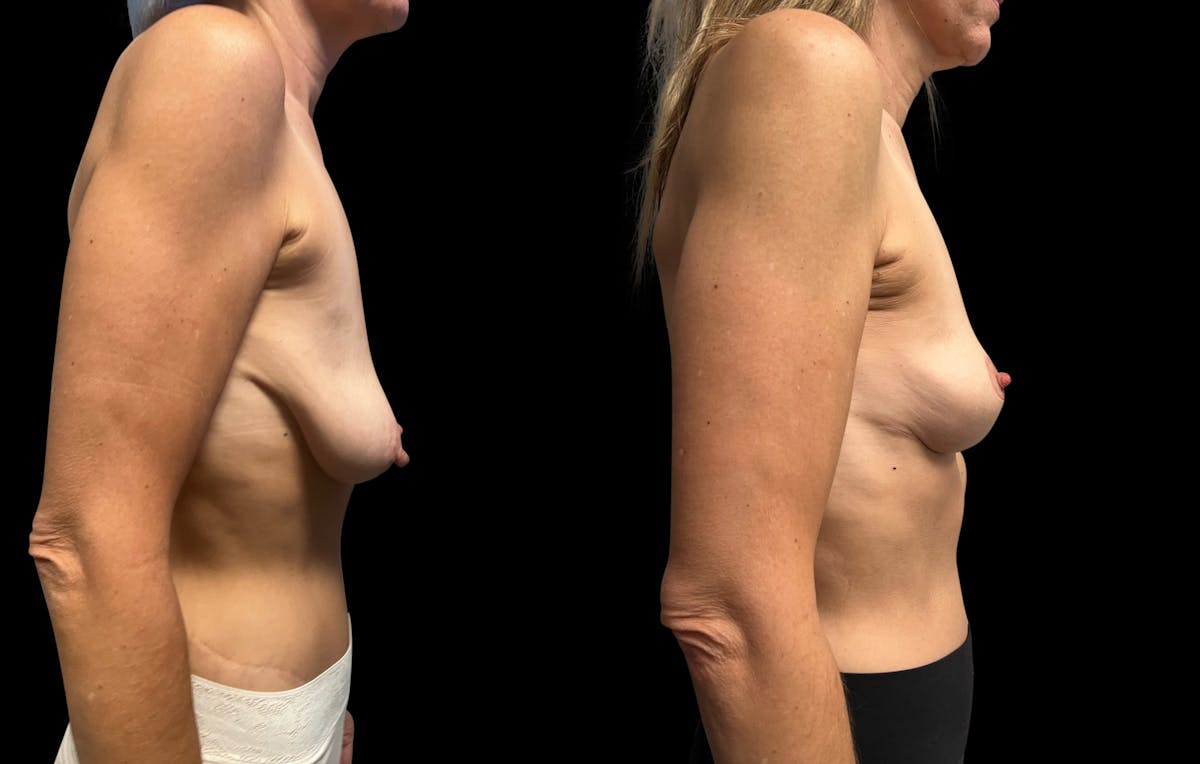 Breast Lift Before & After Gallery - Patient 211158 - Image 3