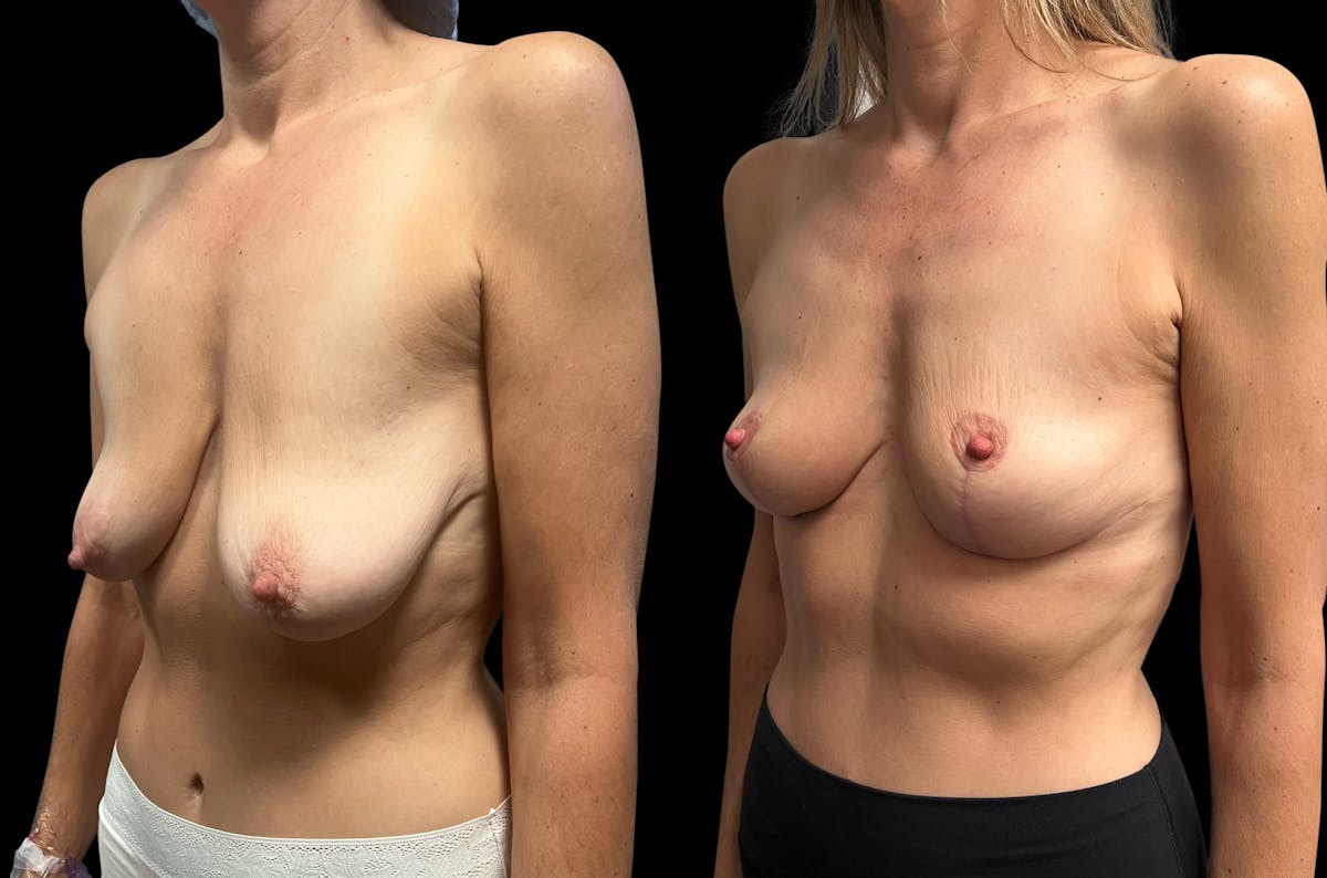 Breast Lift Before & After Gallery - Patient 211158 - Image 4