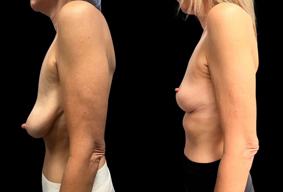 Breast Lift Before & After Gallery - Patient 211158 - Image 5