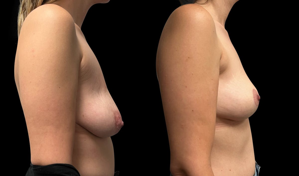 Breast Lift Before & After Gallery - Patient 190561 - Image 3