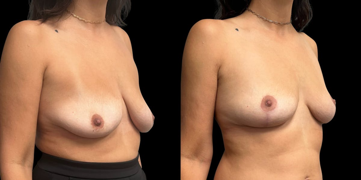Breast Lift Before & After Gallery - Patient 220072 - Image 2