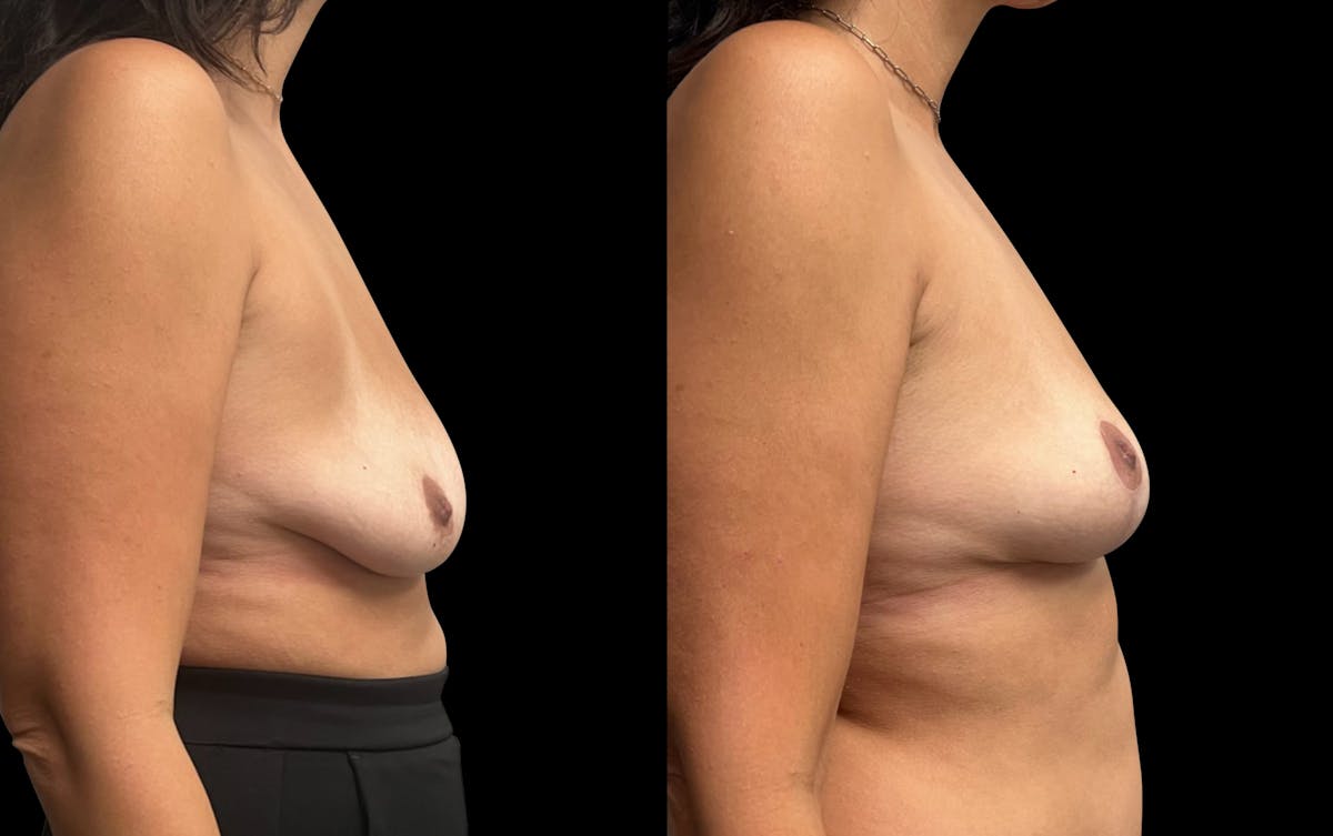 Breast Lift Before & After Gallery - Patient 220072 - Image 3