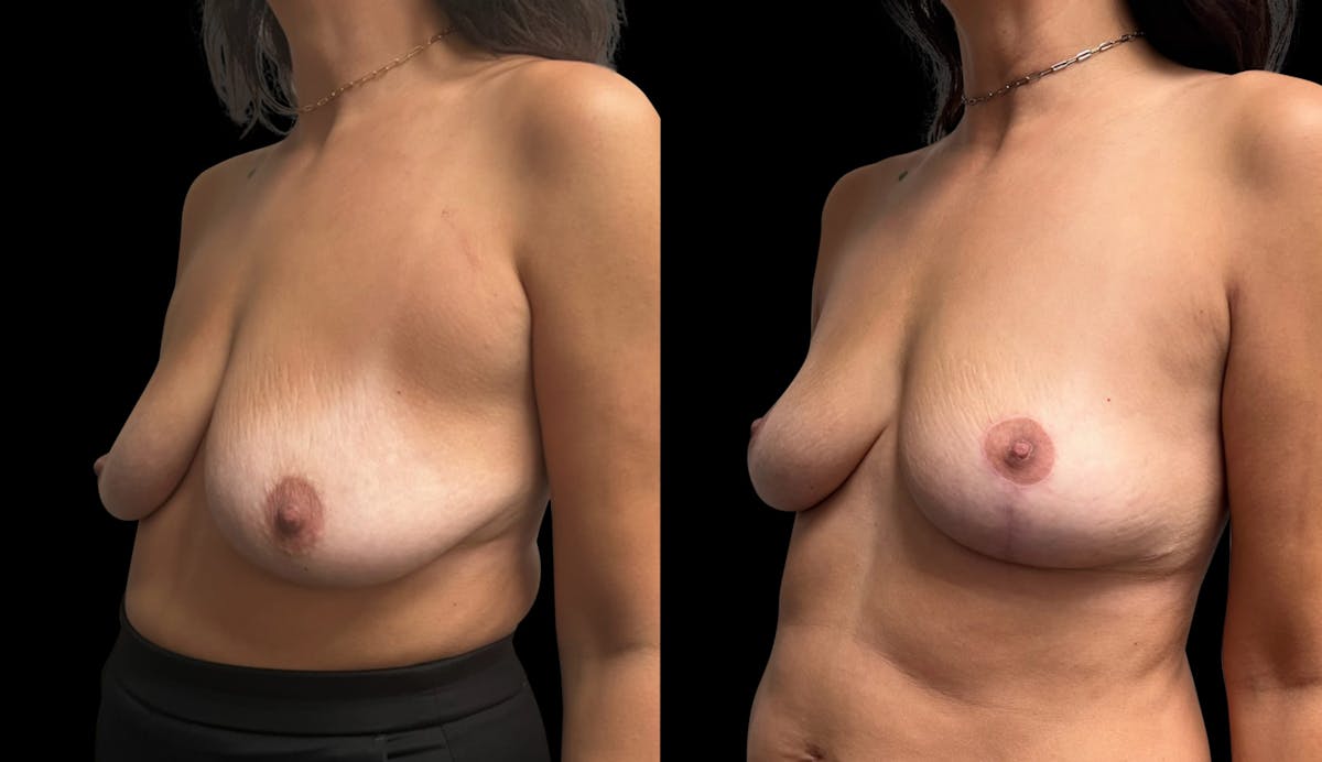 Breast Lift Before & After Gallery - Patient 220072 - Image 4
