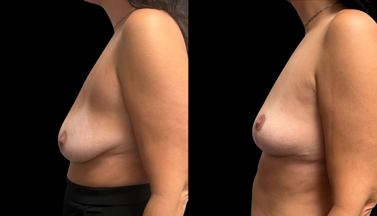 Breast Lift Before & After Gallery - Patient 220072 - Image 5