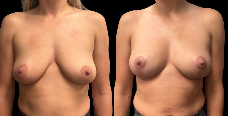Breast Lift Before & After Gallery - Patient 207906 - Image 1