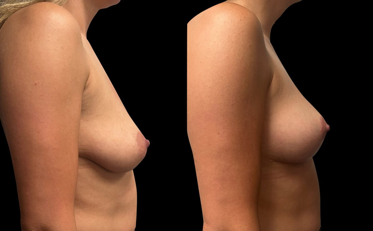 Breast Lift Before & After Gallery - Patient 207906 - Image 3