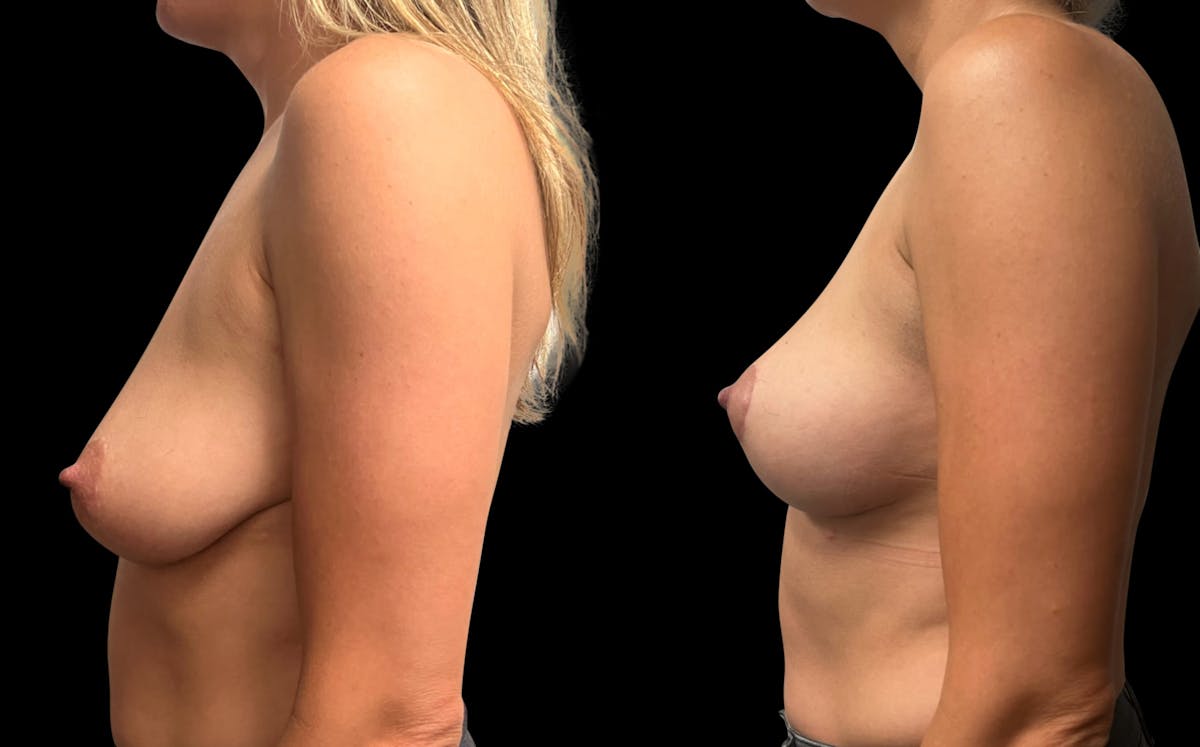 Breast Lift Before & After Gallery - Patient 207906 - Image 5