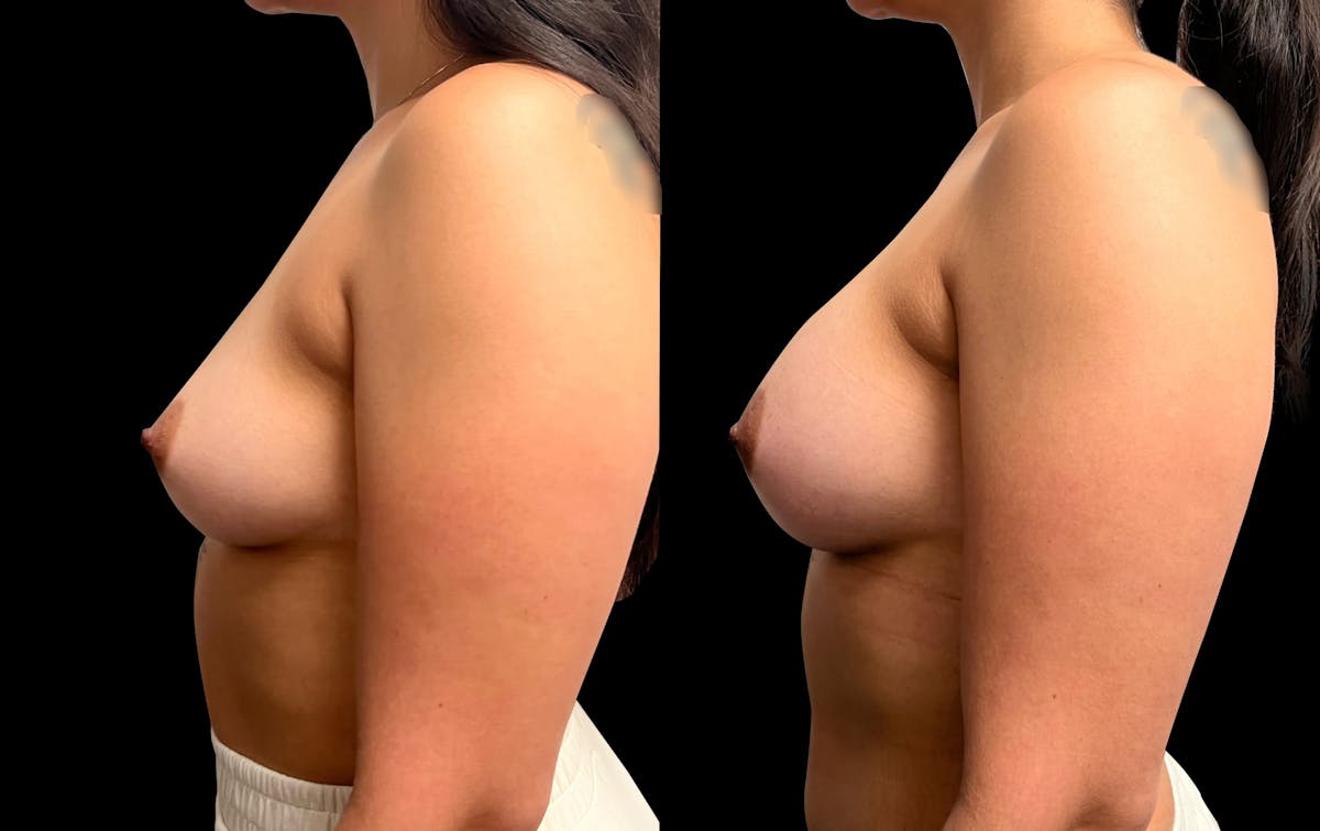 Breast Augmentation with Lift Before & After Gallery - Patient 331430 - Image 5