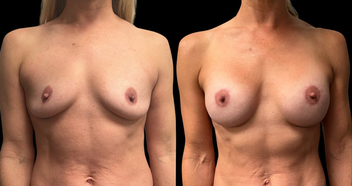 Breast Augmentation with Lift Before & After Gallery - Patient 418392 - Image 1