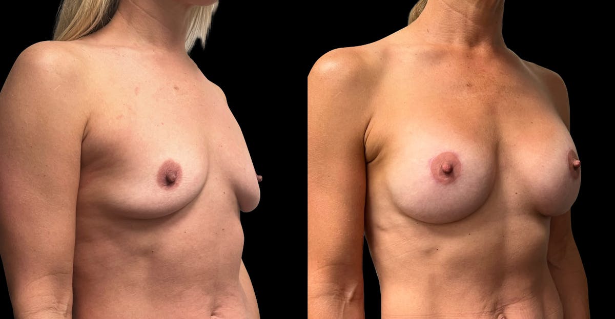 Breast Augmentation with Lift Before & After Gallery - Patient 418392 - Image 2