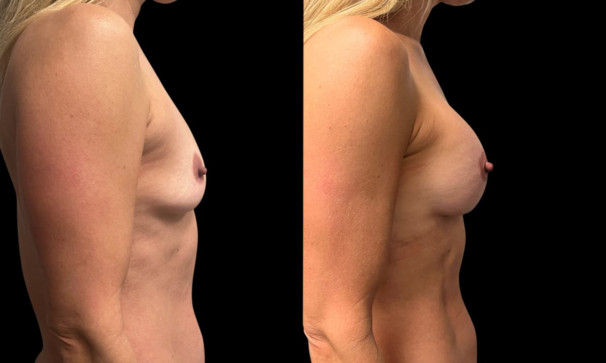 Breast Augmentation with Lift Before & After Gallery - Patient 418392 - Image 3