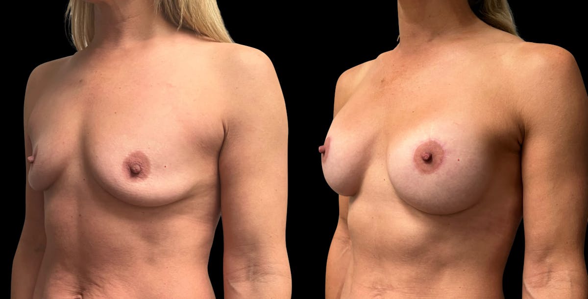 Breast Augmentation with Lift Before & After Gallery - Patient 418392 - Image 4