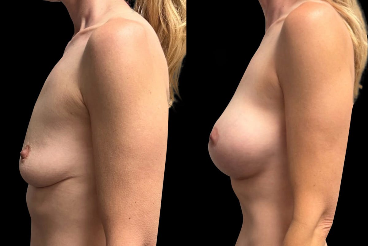 Breast Augmentation with Lift Before & After Gallery - Patient 257243 - Image 5