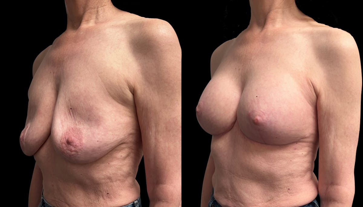 Breast Augmentation with Lift Before & After Gallery - Patient 226226 - Image 4