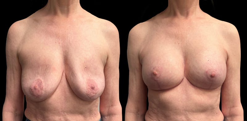 Breast Augmentation with Lift Before & After Gallery - Patient 226226 - Image 1