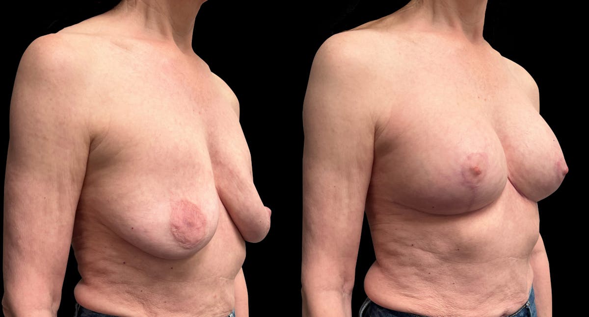 Breast Augmentation with Lift Before & After Gallery - Patient 226226 - Image 2