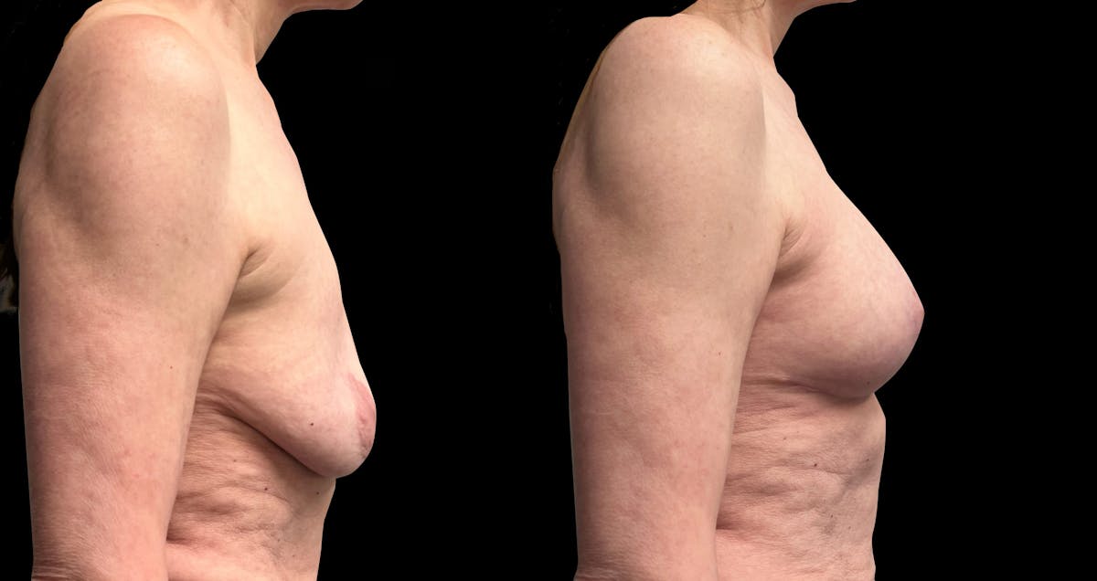 Breast Augmentation with Lift Before & After Gallery - Patient 226226 - Image 3