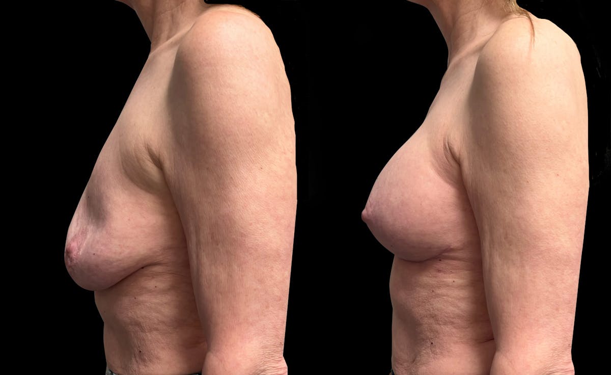 Breast Augmentation with Lift Before & After Gallery - Patient 226226 - Image 5