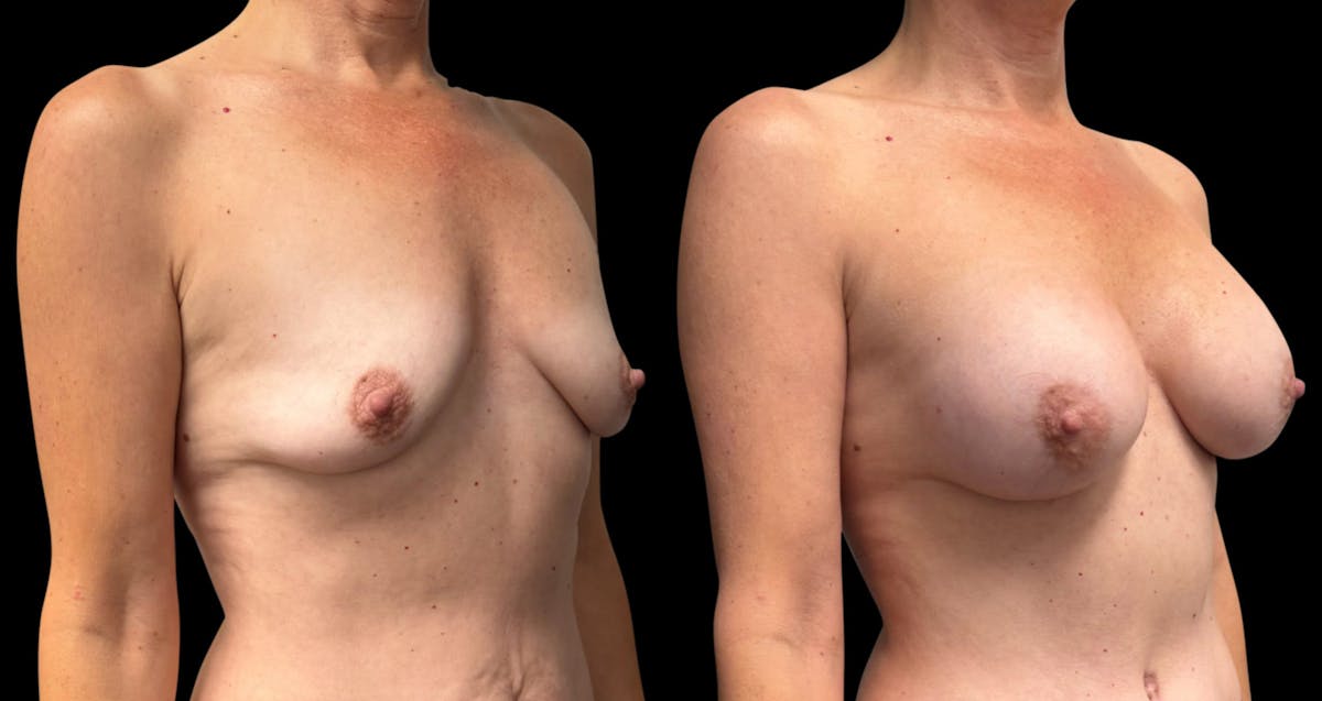 Breast Augmentation Before & After Gallery - Patient 137130 - Image 2