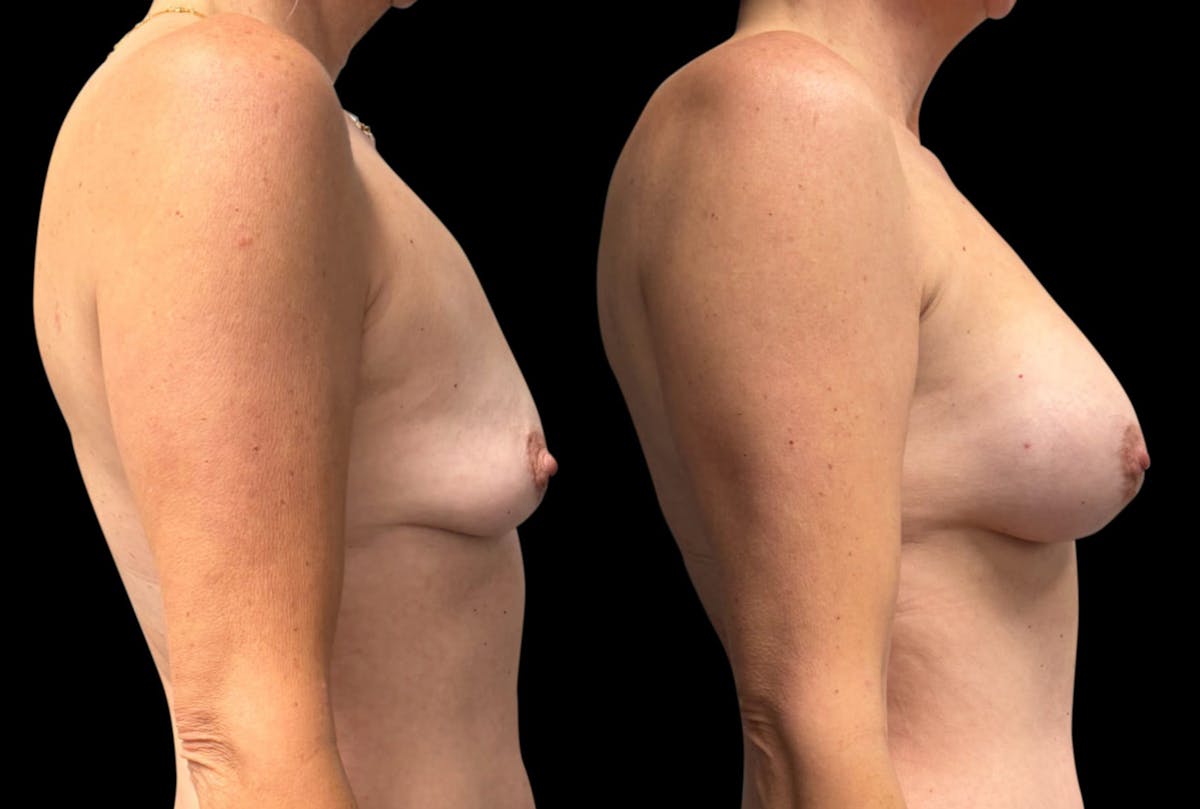 Breast Augmentation Before & After Gallery - Patient 137130 - Image 3
