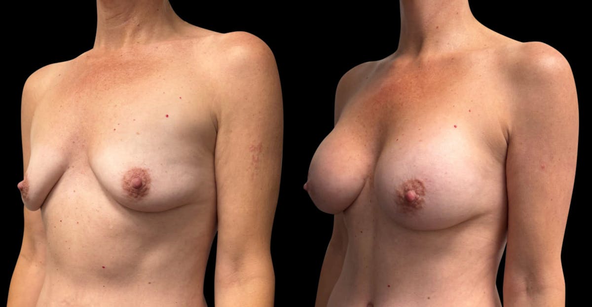 Breast Augmentation Before & After Gallery - Patient 137130 - Image 4
