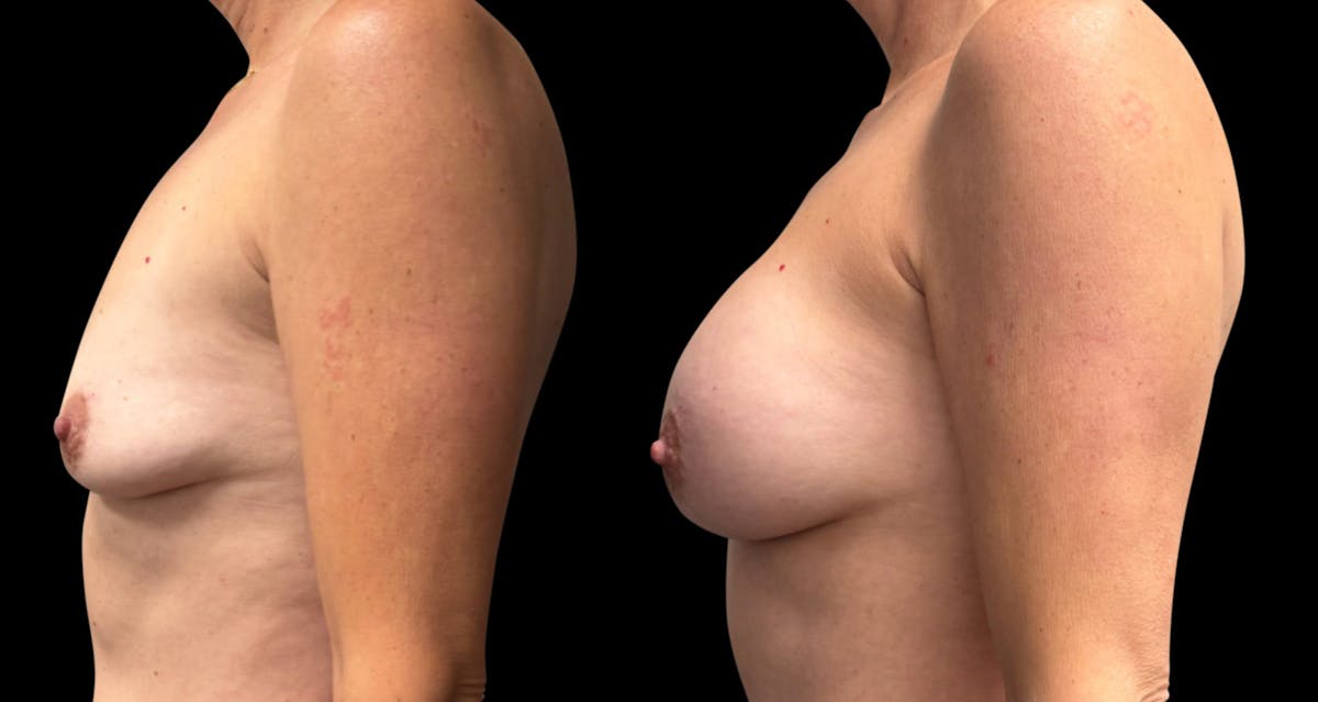 Breast Augmentation Before & After Gallery - Patient 137130 - Image 5