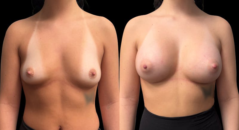 Breast Augmentation Before & After Gallery - Patient 758600 - Image 1