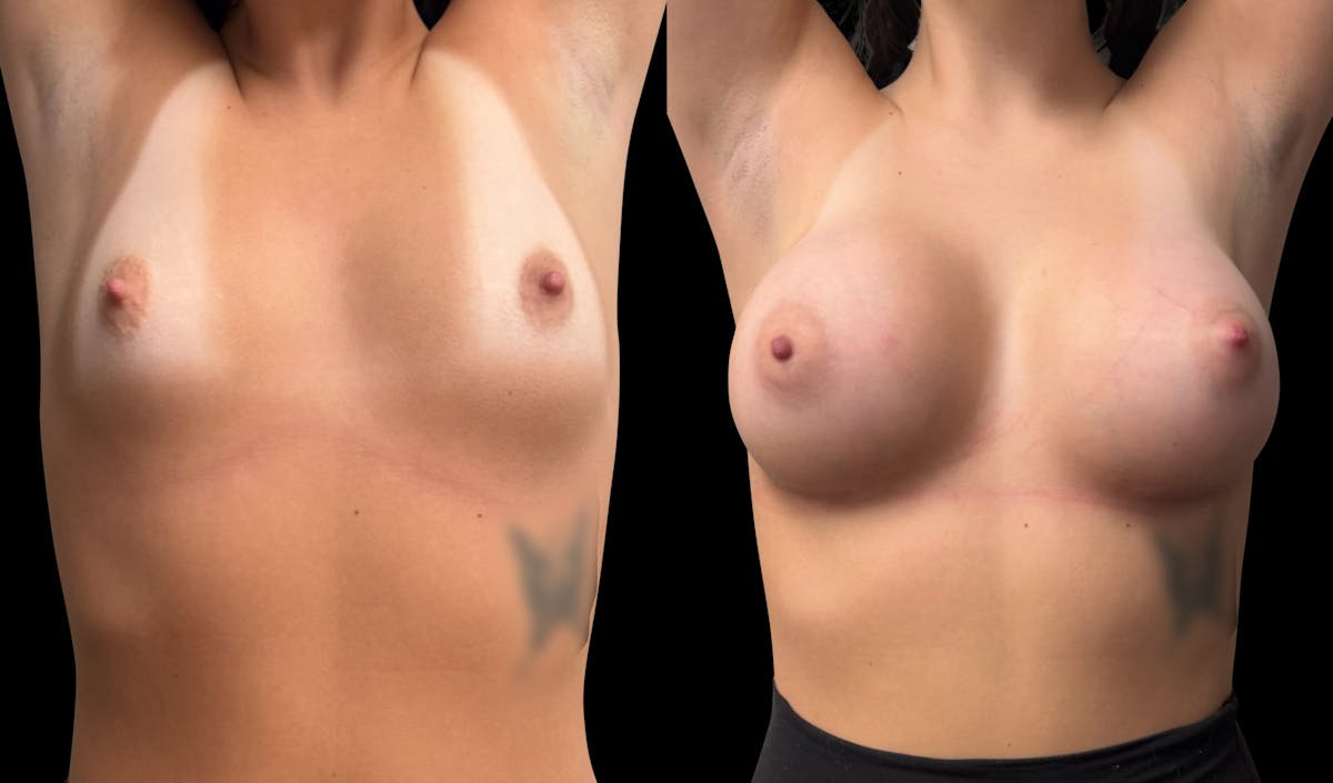 Breast Augmentation Before & After Gallery - Patient 758600 - Image 2