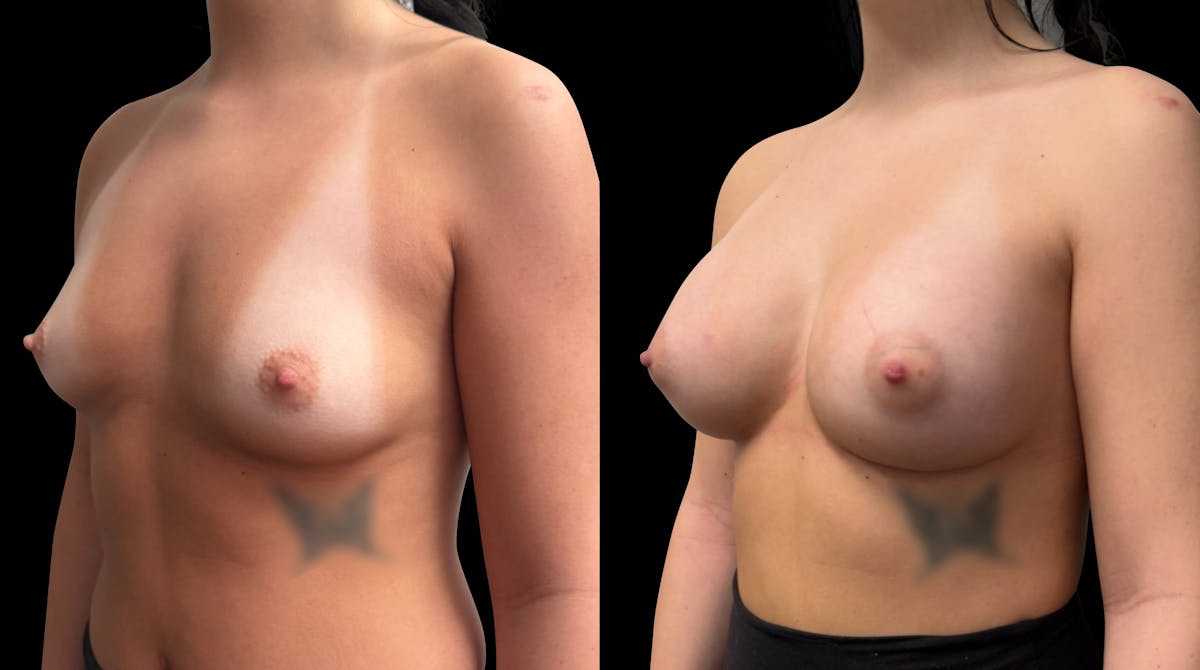 Breast Augmentation Before & After Gallery - Patient 758600 - Image 3