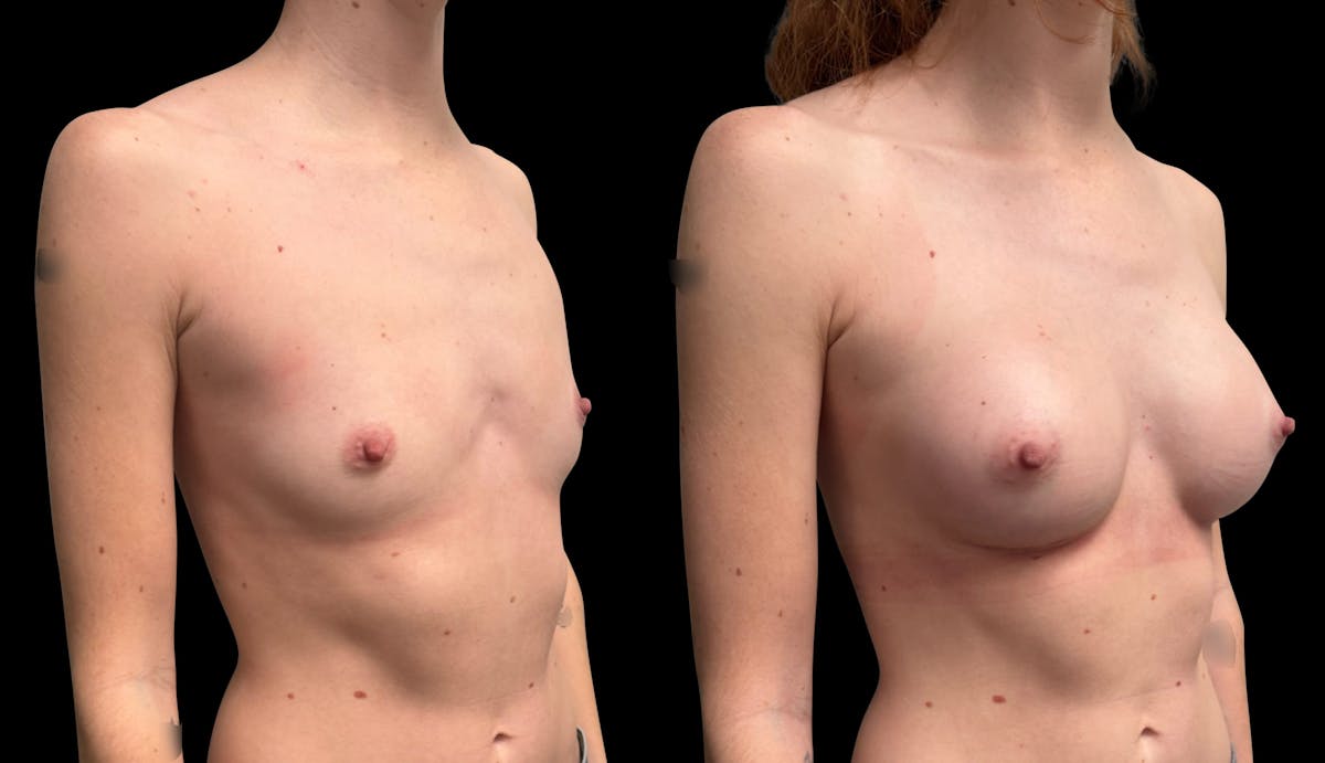 Breast Augmentation Before & After Gallery - Patient 208517 - Image 2