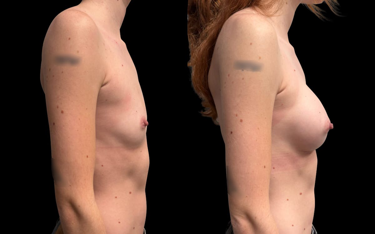 Breast Augmentation Before & After Gallery - Patient 208517 - Image 3