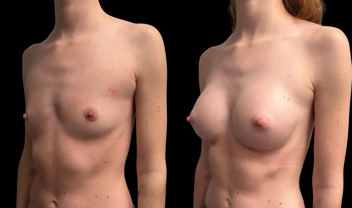 Breast Augmentation Before & After Gallery - Patient 208517 - Image 4