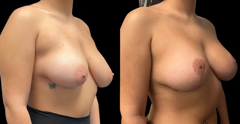 Breast Augmentation with Lift Before & After Gallery - Patient 384510 - Image 1