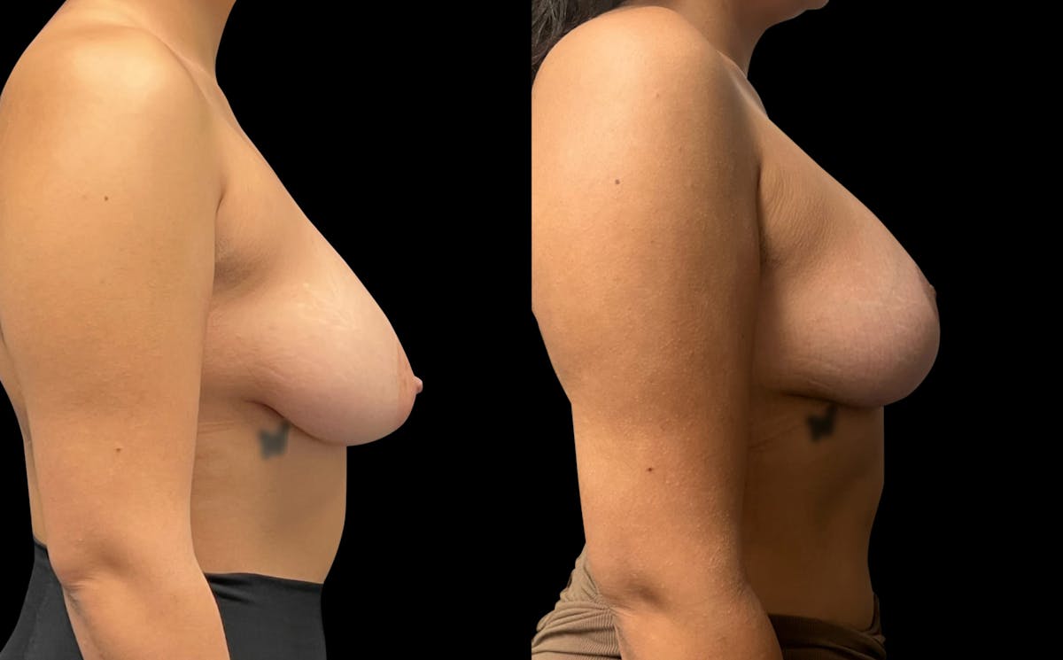Breast Augmentation with Lift Before & After Gallery - Patient 384510 - Image 2