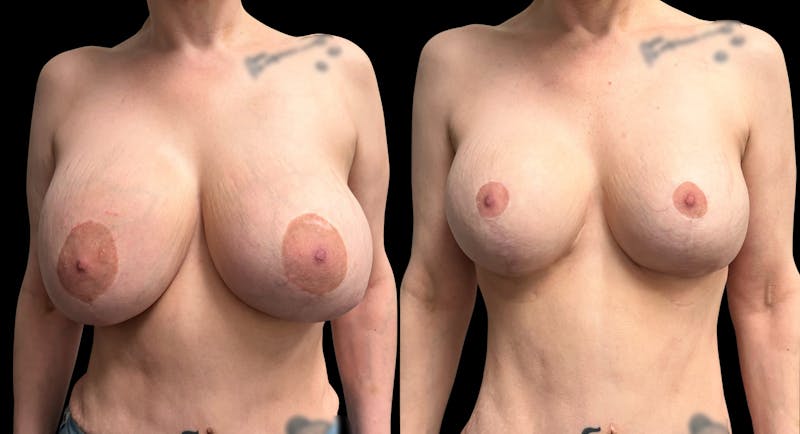 Breast Implant Exchange Before & After Gallery - Patient 808465 - Image 1