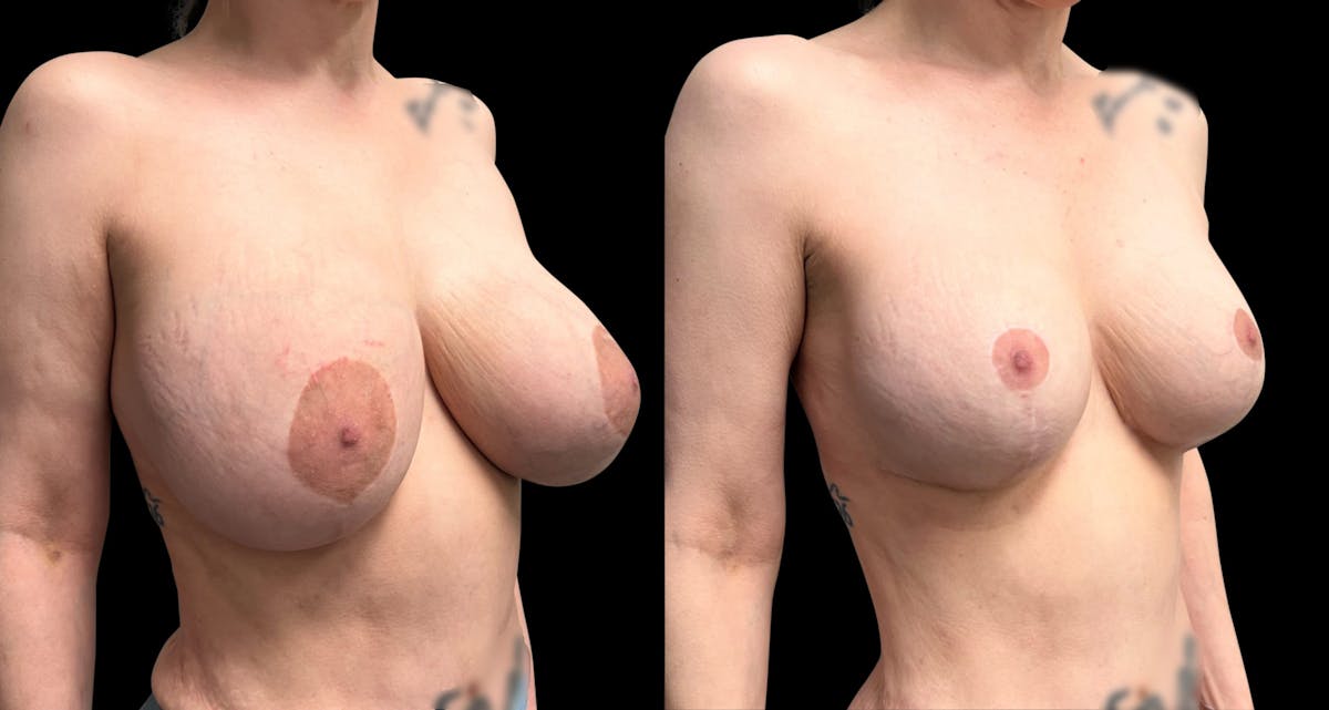 Breast Implant Exchange Before & After Gallery - Patient 808465 - Image 2